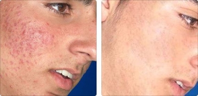 Before and After Acne Treatments